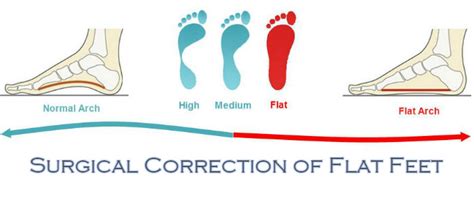 Surgical Correction of Flat Feet: LondonFootandAnkleSurgery.co.uk