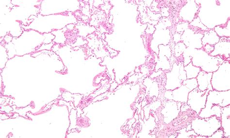 Emphysema Histology Labeled