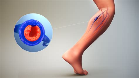 Deep Vein Thrombosis (DVT): Symptoms, Causes, and Treatment