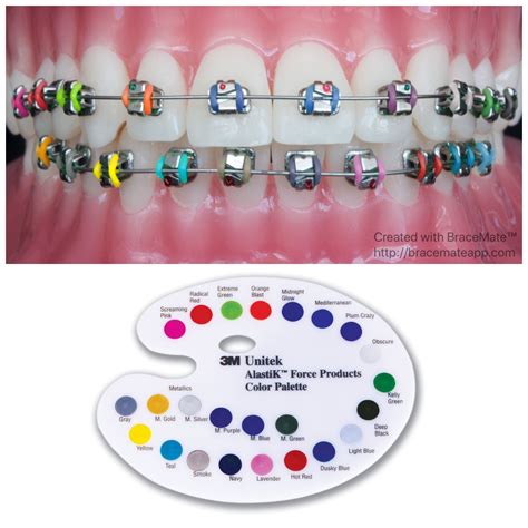 √ Top Braces Colors