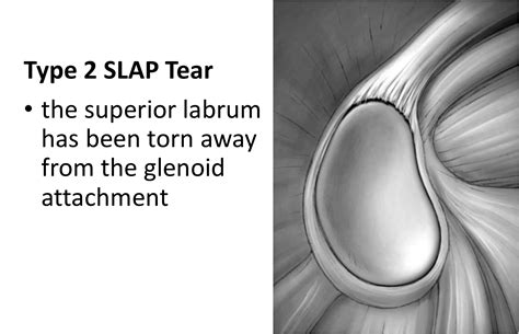 Fig 8. Type 2 - Cambridge Shoulder