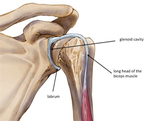 Labral tear - SLAP lesion