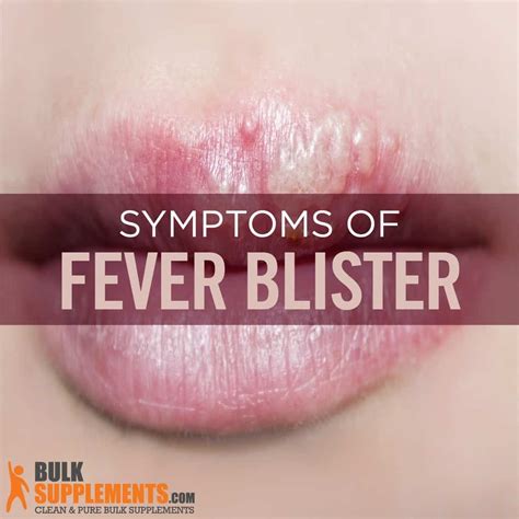 Blisters On Lips Due To Fever | Lipstutorial.org