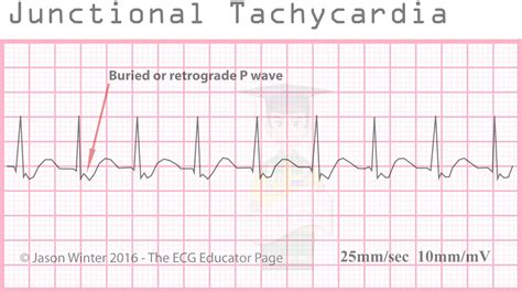 ECG Educator Blog : Junctional Rhythms