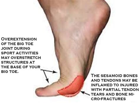 [DIAGRAM] Diagram Of Big Toe Pain - MYDIAGRAM.ONLINE