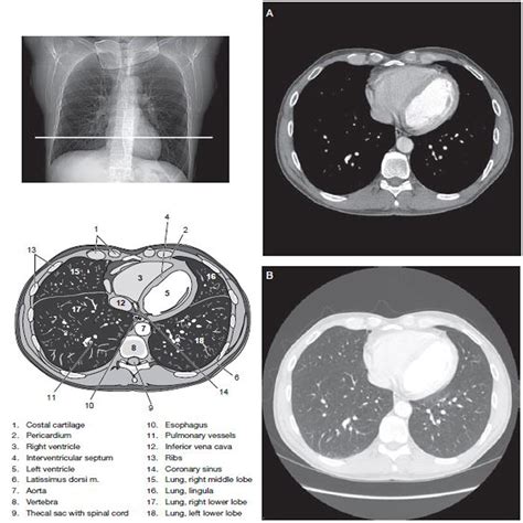 Anatomy Of Chest Ct Scan : Automatic Interpretation Of Chest Ct Scans 4BE