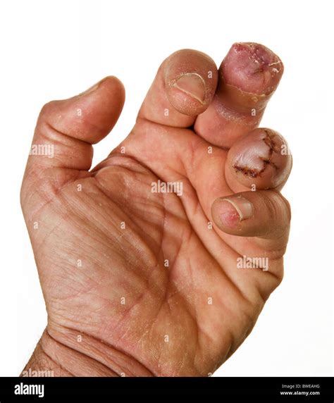 Missing Fingers High Resolution Stock Photography and Images - Alamy