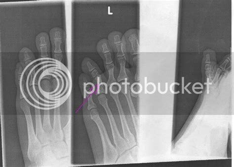 Broken Toe X-Ray Photo by manstwo | Photobucket