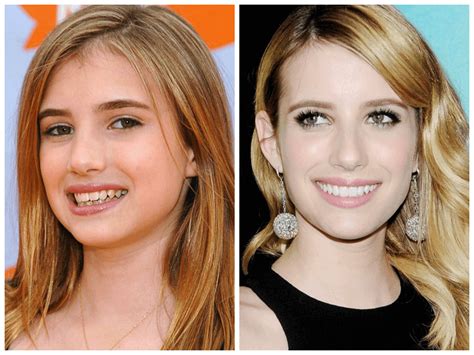 10 Celebrities with Veneers Before and After | Dentgap