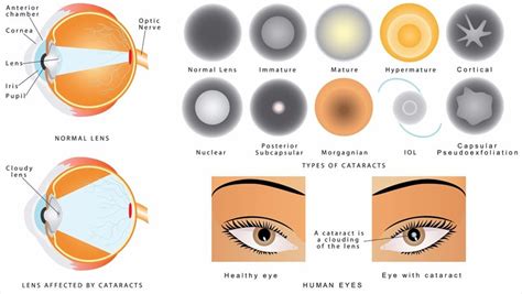 Cortical Cataract