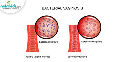 Bacterial Vaginosis: Causes, Symptoms And Treatment