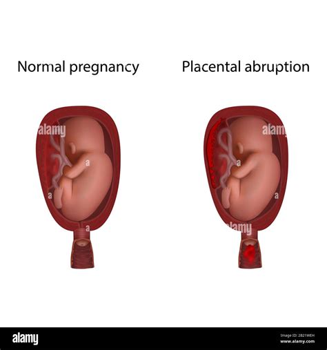 Placental abruption hi-res stock photography and images - Alamy