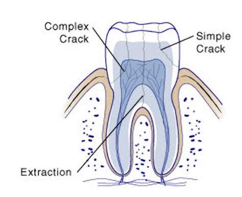 Cracked Tooth Syndrome | FirstBite Dental | Essendon Dentist