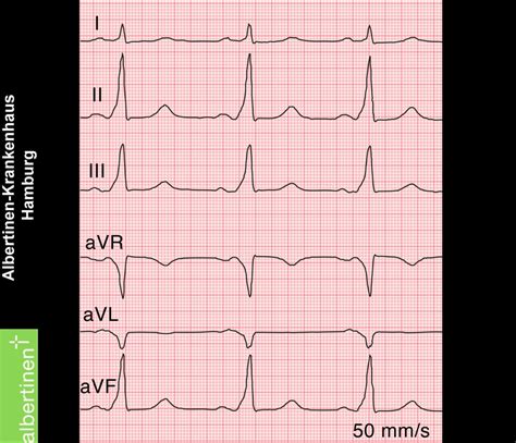 WPW Syndrome (ECG) - DocCheck