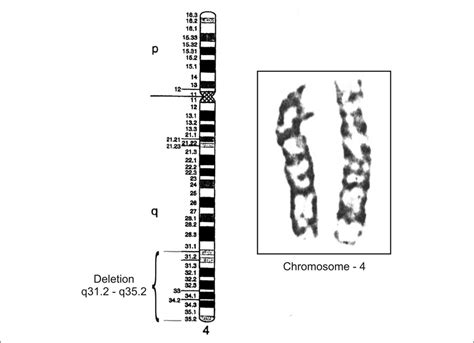 Chromosome 4 Deletion Related Keywords - Chromosome 4 Deletion Long ...