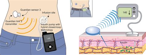 Closed Loop Insulin Pump Systems