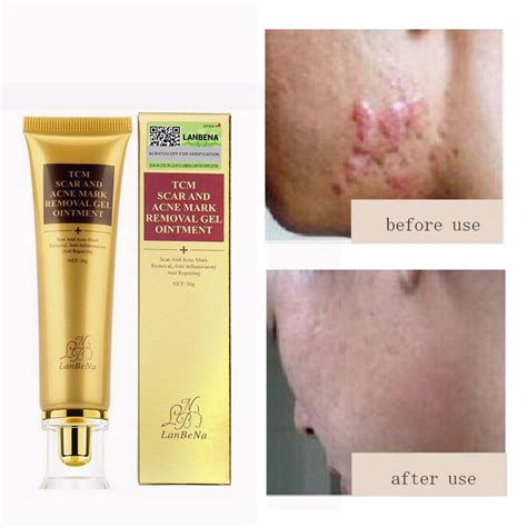 Acne Scar Removal Cream is rated the best in 04/2024 - BeeCost