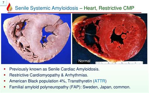 Amyloidosis