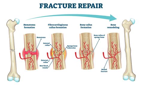 Bone Remodeling After Fracture