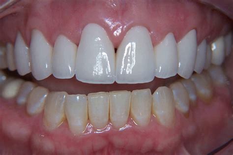 Before and After Dental Crowns Photos