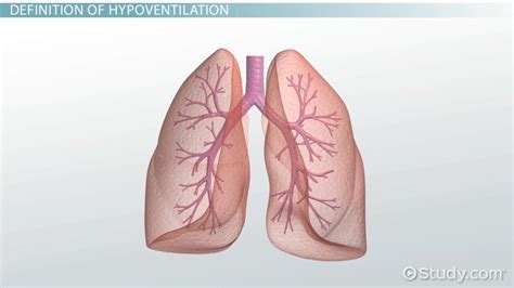 What Is Hypoventilation? - Definition, Causes & Symptoms - Video ...