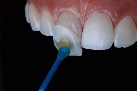 How Have Dental Veneers Changed Over Time? - Pathway Dentists