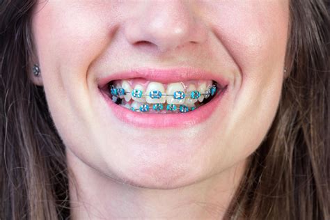 The Amazing Benefits of Braces - Ricard Family Dentistry