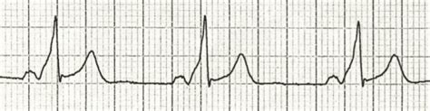 PR Interval • LITFL • ECG Library Basics