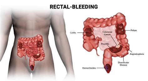 Why Do I Have Bright Red Blood In My Stool? - Manhattan Gastroenterology