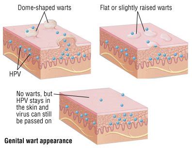 Genital Warts Guide: Causes, Symptoms and Treatment Options