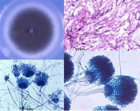 Aspergillus fumigatus: Morphology, Pathogenesis, Lab Diagnosis