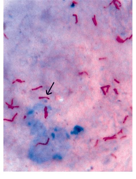 Microphotograph of TB bacillus, Mycobacterium tuberculosis on an ...