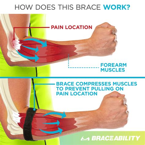 Epicondylitis Brace | Elbow Strap for Medial & Lateral Epicondyle Pain