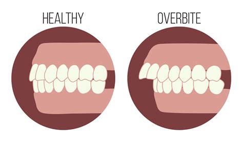 Overbite or "Buck Teeth": THE STEPS TO THE SMILE YOU'VE ALWAYS WANTED ...