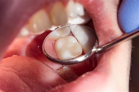 Are Premolars Present in Milk or Baby Teeth? - Triangle Pediatric Dentistry