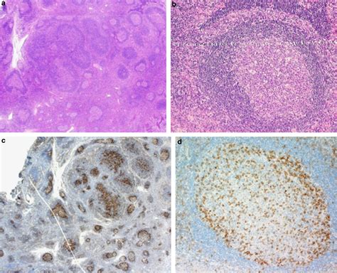 TFH cell markers in reactive lymphoid hyperplasia. (a, b) Hyperplastic ...