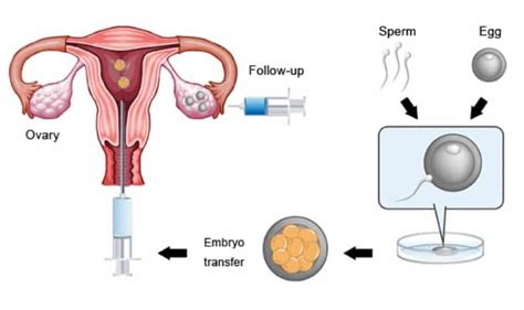 Embryo Transfer | Nurture Fertility Centre & Women's Specialty Clinic