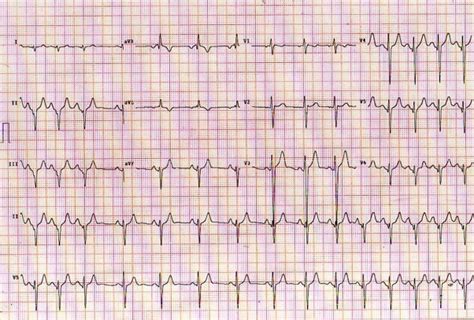 Intermittent delta waves mimics inferior myocardial infarction in young ...