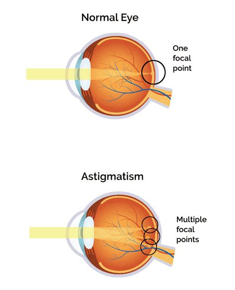 Astigmatism Diagnosis & Treatment in Sanford | Advanced EyeCare