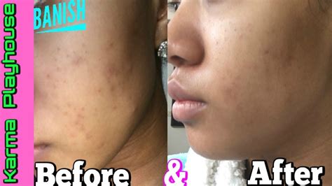 How To Fade Acne Scars FAST BANISH ACNE SCARS Review REAL RESULTS Karma ...