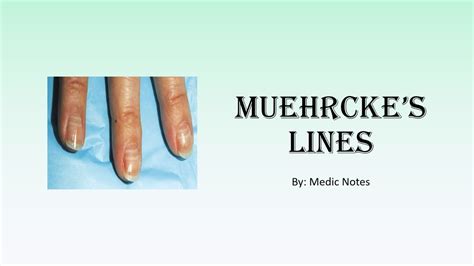 Muehrcke's lines causes and pathophysiology - YouTube