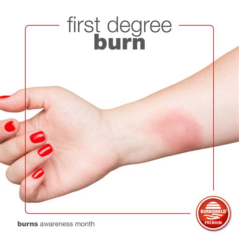 First Degree Burn First Aid