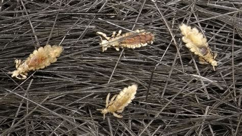 Head lice resistant to over-the-counter treatments in 25 states - ABC7 ...