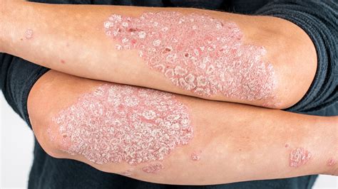 Manage and Understand Your Psoriasis — New River Dermatology