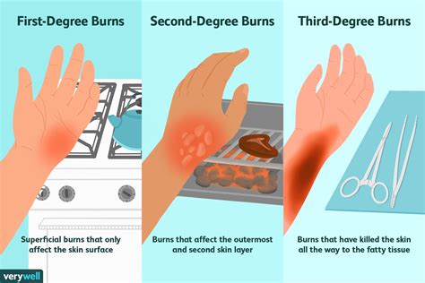 Second Degree Burn Pictures