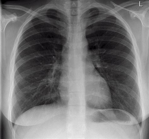 Reading The Chest X-Ray (Chest Radiography): Identifying A Normal Chest ...