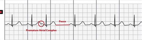 Sinus rhythm with pac ecg 671152-Sinus rhythm with pac treatment