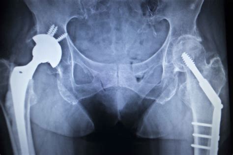 Major Device Complications Alleged in DePuy ASR Hip Replacement Lawsuit ...