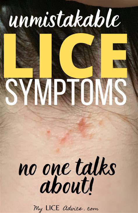 17 Lice Symptoms with Pictures: Signs That You Have Head Lice - My Lice ...