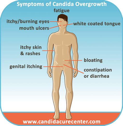 Candida Albicans Overgrowth Symptoms | Candidiasis Symptoms